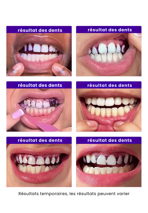 Bandes blanchissantes V34 - Dentiva